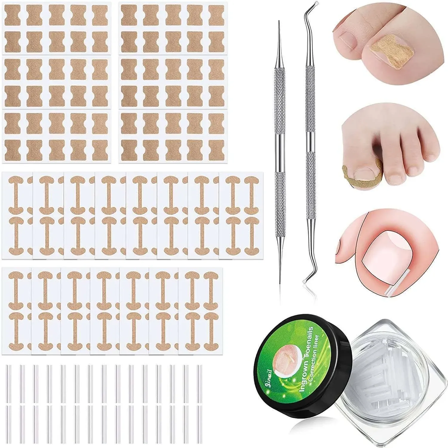 Lanties 152 Pieces Ingrown Toenail Corrector Treatment Tool Sets Include Curved ...